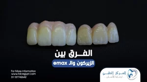 الفرق بين تركيبات الزيركون وال emax | المركز الطبي لرعاية الأسنان