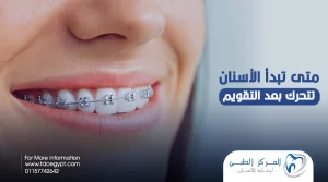 متى تبدأ الأسنان تتحرك بعد التقويم ؟ المركز الطبي لرعاية الأسنان