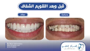 التقويم الشفاف قبل وبعد | المميزات والعيوب