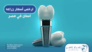 ارخص اسعار زراعة الاسنان في مصر