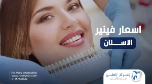اسعار فينير الاسنان 