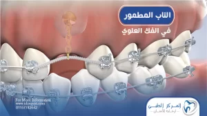 الناب المطمور في الفك العلوي