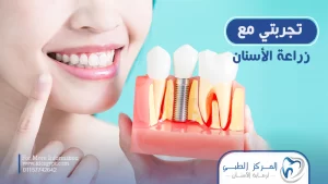 تجربتي مع زراعة الأسنان في المركز الطبي لرعاية الأسنان