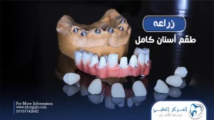 زراعة طقم أسنان كامل