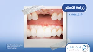 زراعة الاسنان قبل وبعد