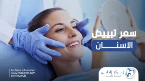 سعر تبييض الاسنان، وانواع التبيض وفوائده