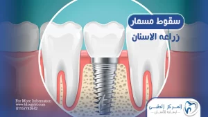 سقوط مسمار زراعة الاسنان