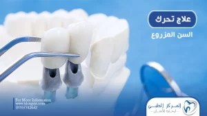 علاج تحرك السن المزروع