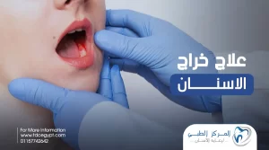 علاج خراج الاسنان، الأنواع، الاسباب و طرق العلاج