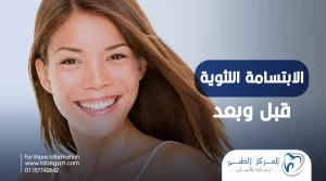 الابتسامة اللثوية قبل وبعد
