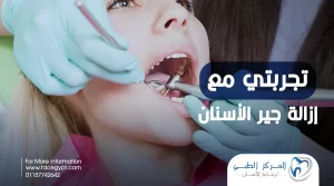 تجربتي مع إزالة جير الأسنان