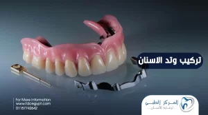 تركيب وتد الاسنان، المميزات،العيوب والسعر