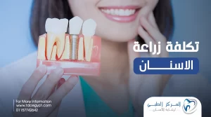 تكلفة زراعة الاسنان في مصر لعام 2023 | أحدث الأسعار