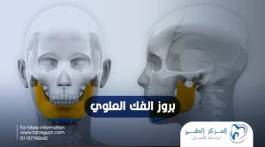 علاج بروز الفك العلوي