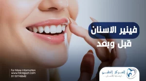 فينير الاسنان قبل وبعد